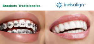 Invisalign NO Funciona